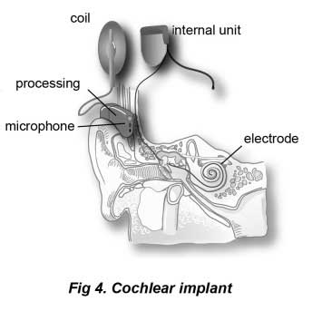 Fig4_Cochlear_Implant