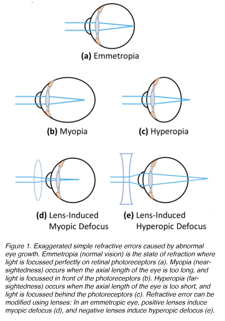 Myopia Fig1