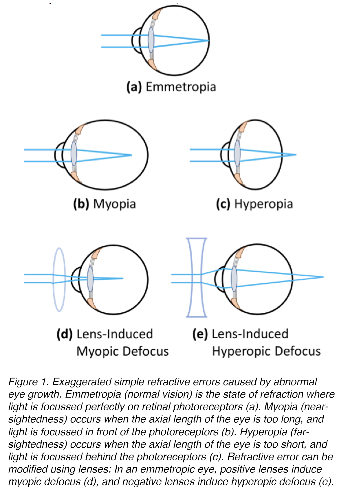 myopia myopia és hyperopia