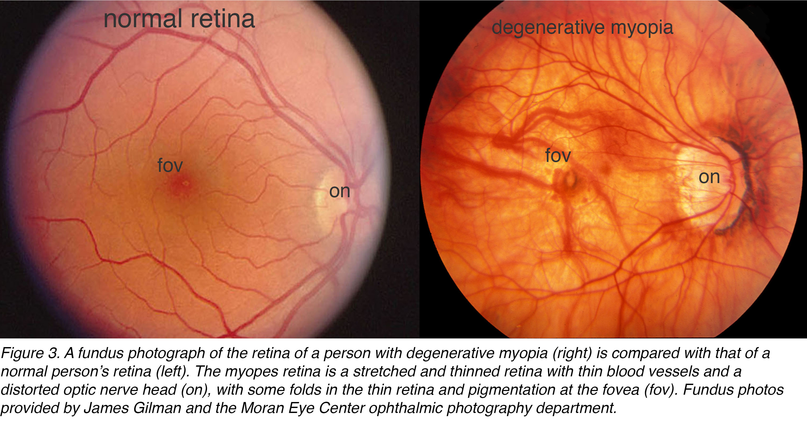 sclera myopia