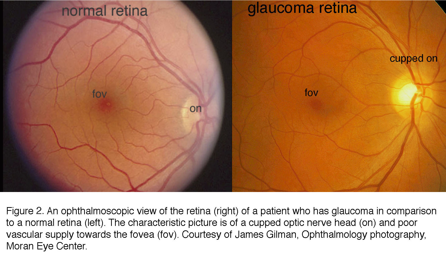 hyperopia és glaucoma