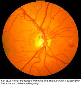diabretina