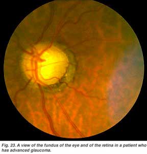 glaucretina